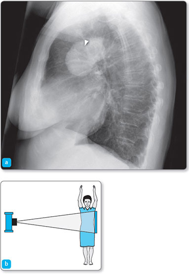Lateral Chest X Ray Positioning