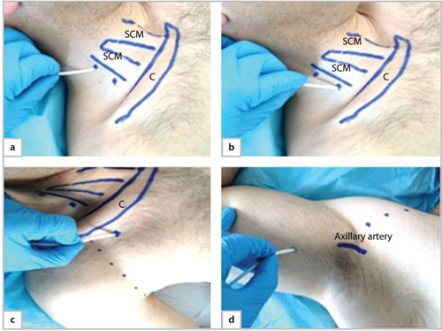 Axillary Brachial Plexus Block Landmark Technique