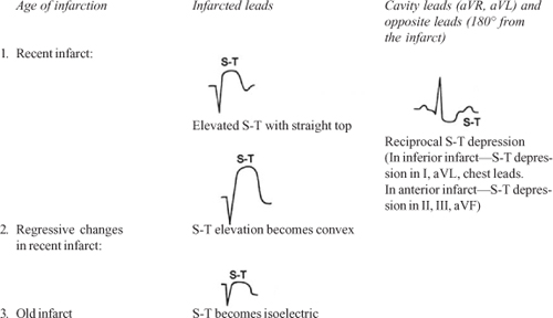 What Does An Anterior Infarct Look Like On An Ecg