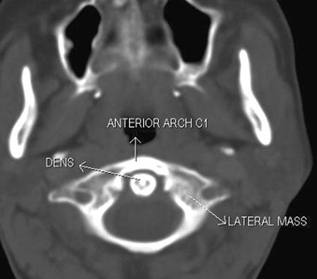 Dens Anatomy Ct