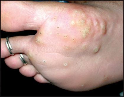 melanotic whitlow photos Living with herpetic whitlow from genital herpes