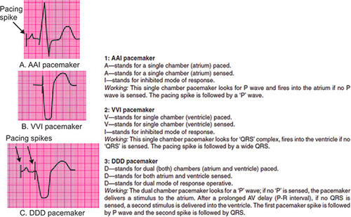 Wandering Atrial Pacemaker Criteria