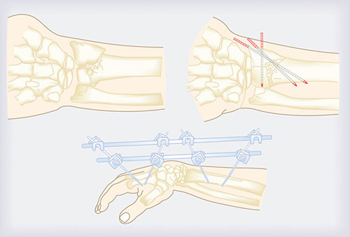 Reverse Colles Fracture