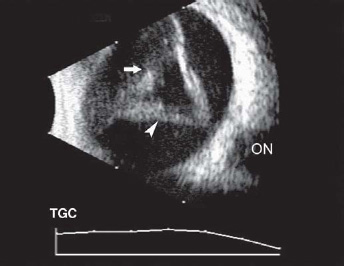 Retinal Repair Radiopaedia Retinal Detachment Ultrasound Radiopaedia