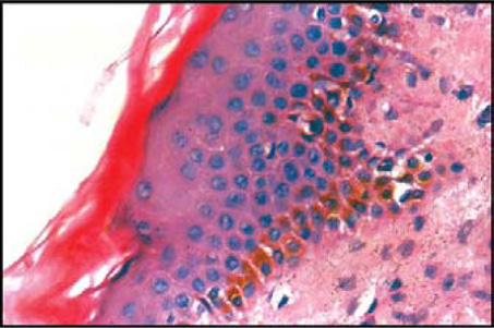 melanotan express reddit Multifocal pigmented lesions in the maxilla main image 0