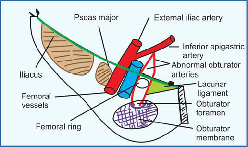 Femoral Ring Boundaries