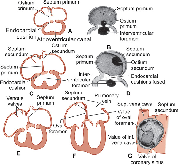 Development Of Interventricular Septum Flowchart Development Of Interventricular Septum Flowchart