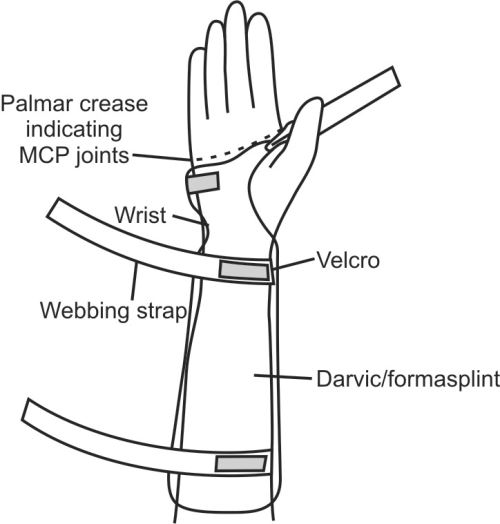 Classic cock-up wrist splint diagram showing palmar crease, wrist strap, and splint components