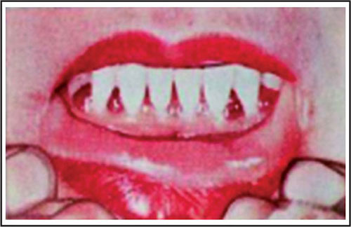 vitamin c deficiency lips JaypeeDigital