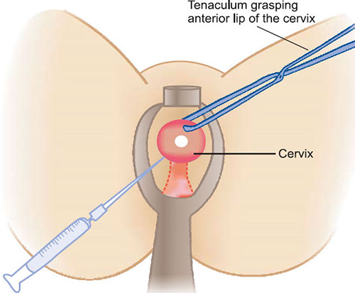 anterior cervical lip c section This is my most viewed blog post. It has been updated and moved to my website. "Summary: An is a normal part of the birth process. It does not Understanding Cervical Lip During Labor