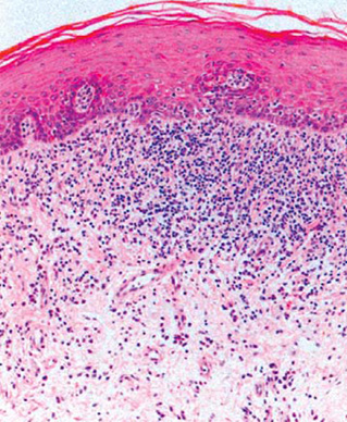 melanotan express reddit Case 30- This case exemplifies why every “dentigerous cyst” requires biopsy  for histologic diagnosis, as this one at the site of tooth #17 turned out  to be a solid ameloblastoma with classic main image 1