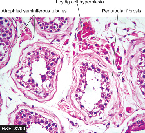 Testicular Atrophy Histology Diagram