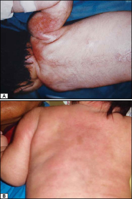 bullosis diabeticorum emedicina diabetes