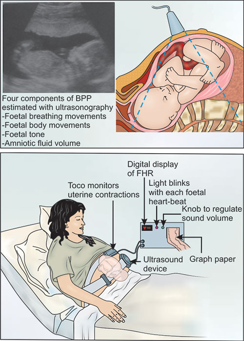 Biophysical Profile Interpretation