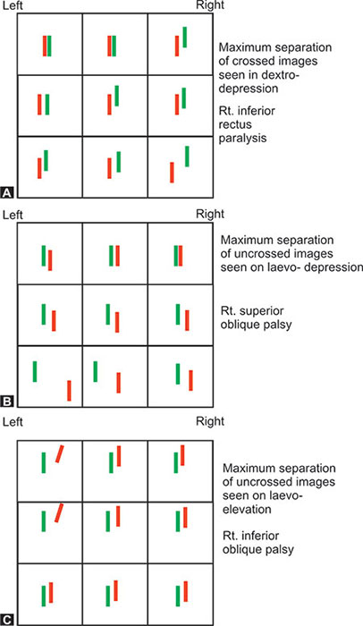 Diplopia Charting Examples Superior Oblique Palsy Diplopia Charting