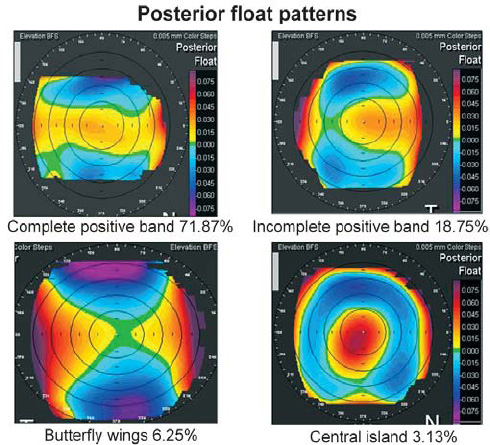 Posterior Float Posterior Float Keratoconus
