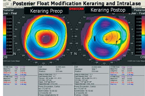 Posterior Float Posterior Float Keratoconus