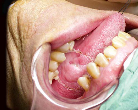 edema de reinke grau ii