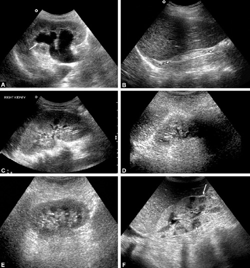 Renal Parenchymal Disease Ultrasound Grading