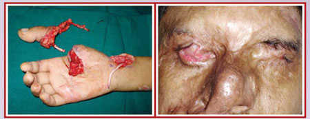 cigarette burn healing stages JaypeeDigital