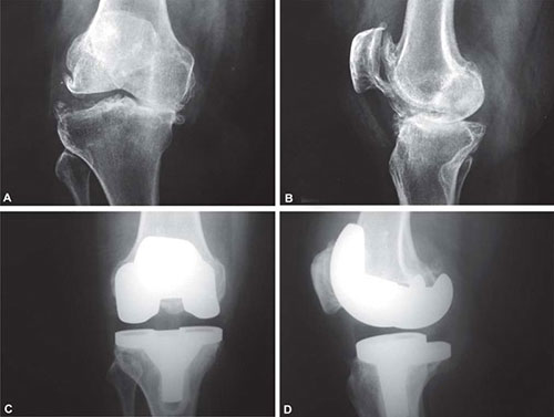 clinical study b12 injection osteophyte About Bone Spurs (Osteophytes) The feasibility and safety of