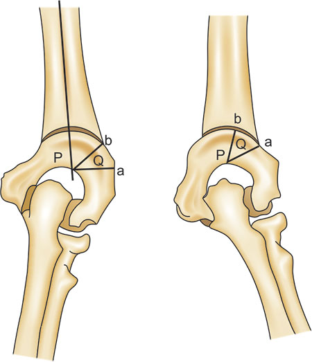 What Is Cubitus Varus