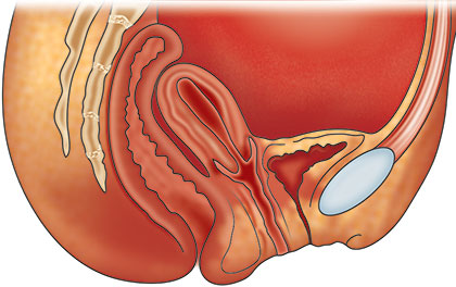 Inverted Uterus Diagram