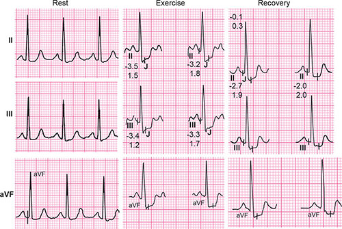 St Segment Depression During Stress Test