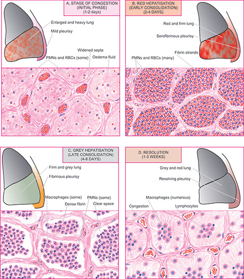 Lobar Pneumonia Stages 4 Stages Of Pneumonia: Symptoms, Diagnosis And