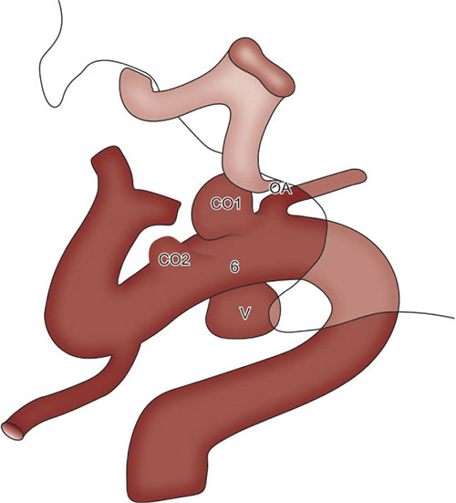Paraclinoid Aneurysm Anatomy