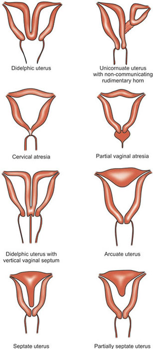Vaginal Atresia