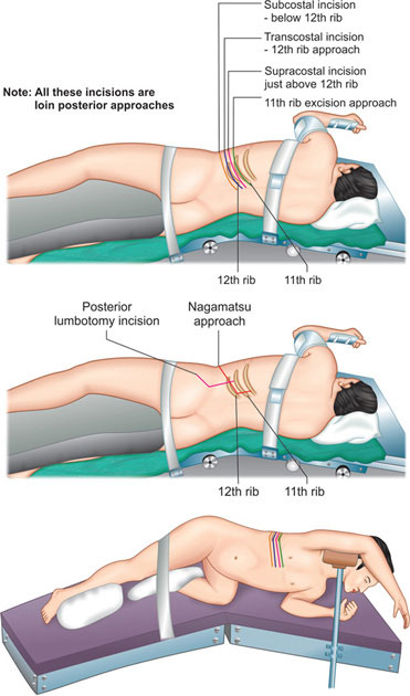 Simple Flank Incision Subcostal Incision Wwwurologytextbookcom