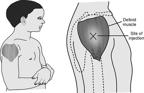 Delmus Injection Intramuscular Injection Deltoid Landmarks