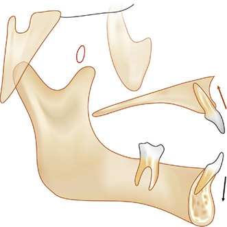 Maxilla Rotation Device Clockwise Rotation Of Maxilla