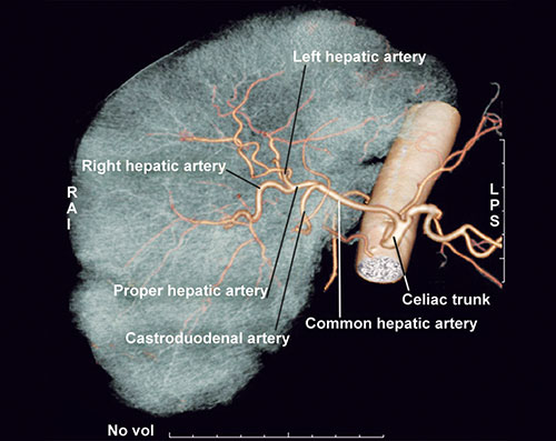 Hepatic Artery Proper And Common Hepatic Artery