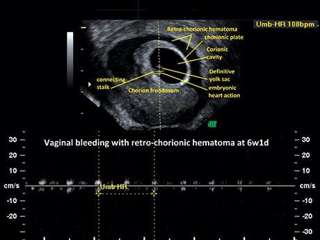 Chorionic Bump Scan Chorionic Cavity Ultrasound
