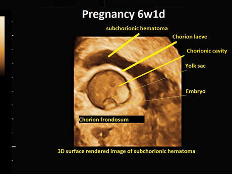 Chorionic Bump Scan Chorionic Cavity Ultrasound
