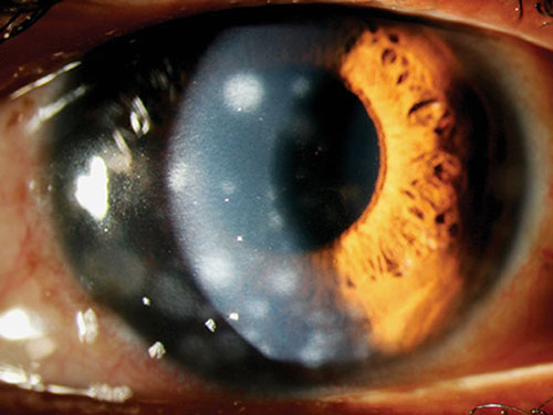 Nummular Keratitis