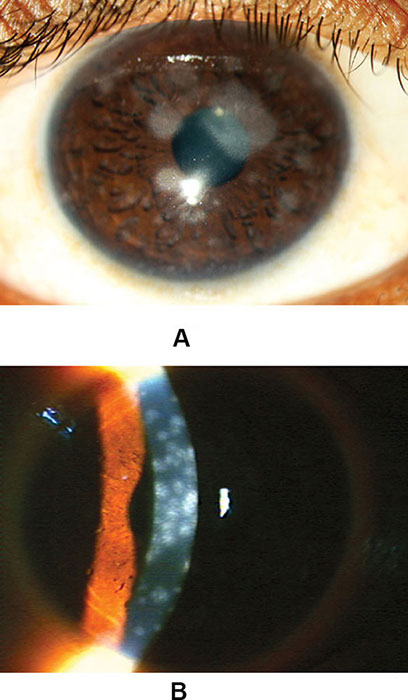 Nummular Keratitis