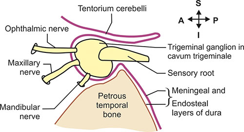 Trigeminal Impression For Trigeminal Ganglion