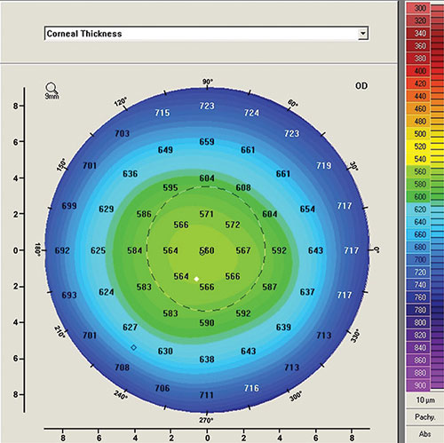 Normal Corneal Thickness Topography