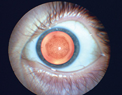 Oil Droplet Cataract Oil Droplet Cataract