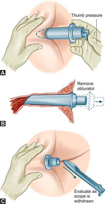 Using Anoscope How Does An Anoscope Work