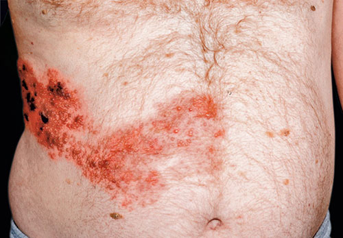 Herpes zoster - roses from hell - dermatomal hemorrhagic vesicular rash on the trunk