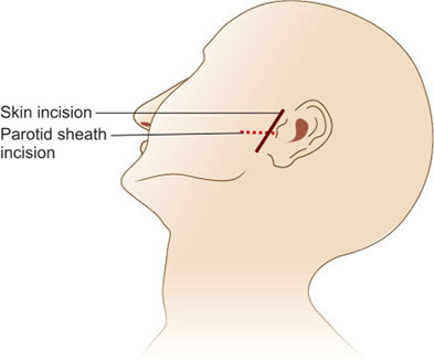 Parotid Incision Types Incision And Drainage Of Parotid Duct Abscess Springerlink