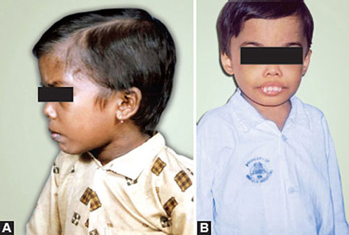 Talasemia Mayor: Panduan Perawatan Transfusi dan Terapi Chelation yang Perlu Diketahui