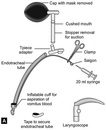Endotracheal Tube Suctioning Procedure