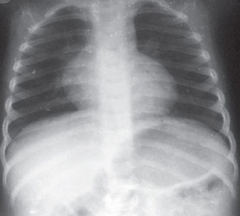microcardia refers to what