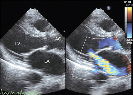 Echo Features Of Mitral Valve Prolapse echo-features-of-mitral-valve-prolapse