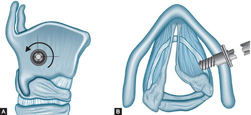Airway Enlargement By Laser Arytenoidectomy In Bilateral Vocal Cord Download Scientific Diagram